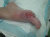 Donar in het ziekenhuis met zijn ontstoken voet (26kb)